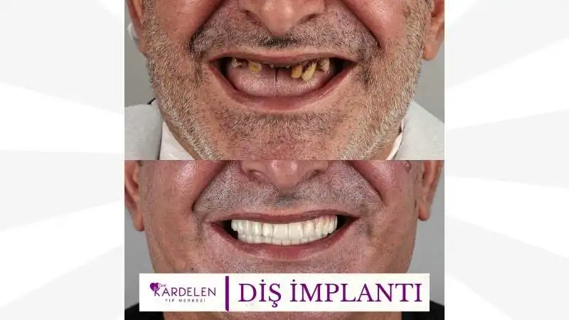 Diş İmplantı 2