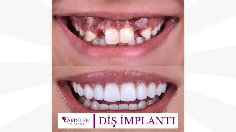 Diş İmplantı