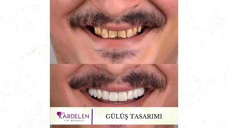 Gülüş Tasarımı (Hollywood Smile)